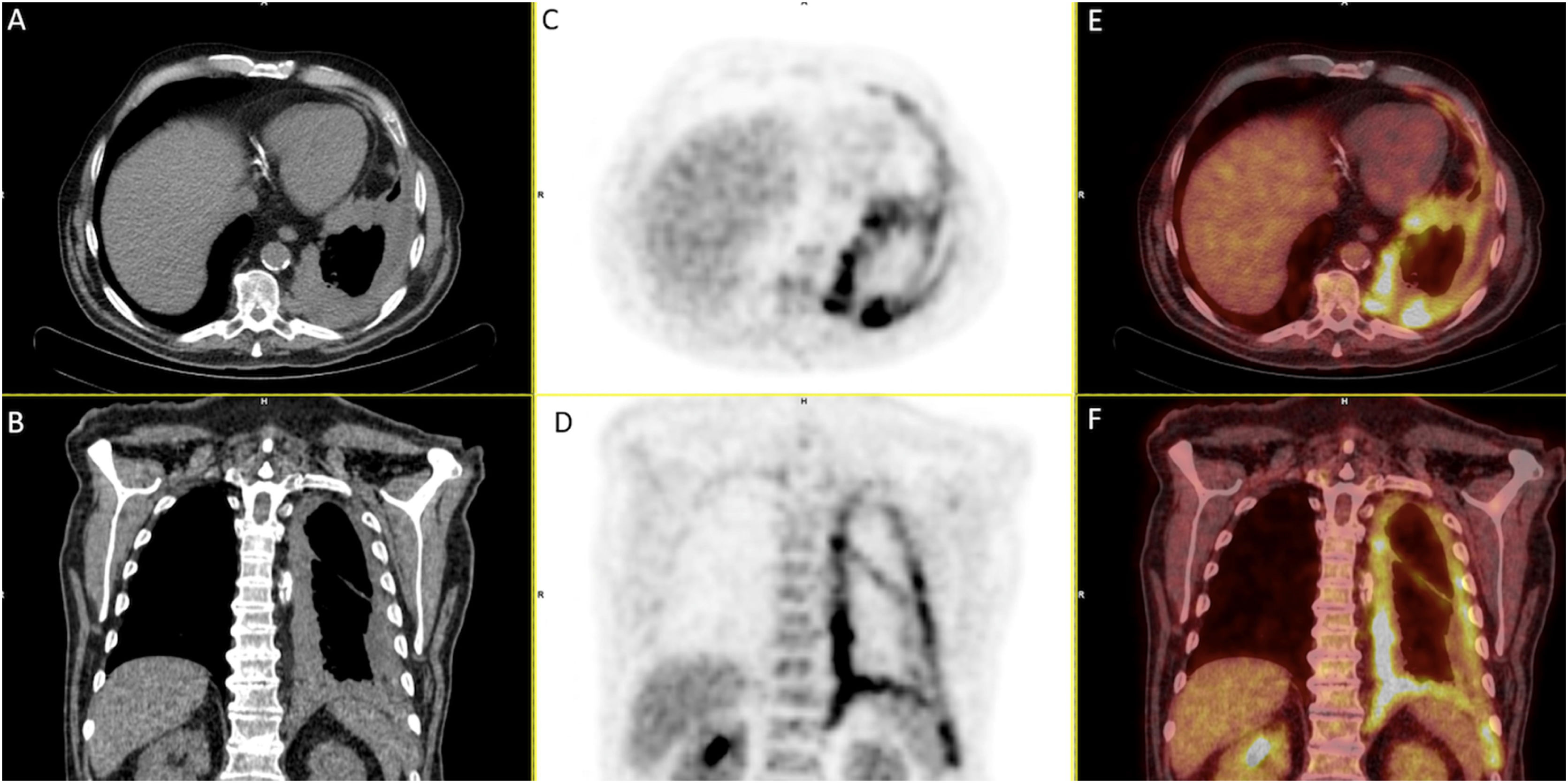 Malignant Pleural Effusion: A Multidisciplinary Approach | Open ...