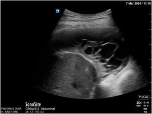 Septate pleural effusion.