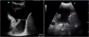Pleural and diaphragmatic nodules.