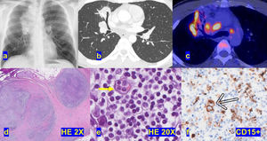(a) Chest radiography showed an opacity in the right upper lobe (RUL). (b) A chest CT showed a RUL 5cm×5cm opacity with air bronchogram and enlarged mediastinal lymph nodes. (c) PET/CT. (d) (HE× 2) and (e) (HE× 20). Histologic features of the biopsy. RS cell (arrow). (f) (Immunohistochemistry, ×20) CD15 positive RS cell (arrow) on a background of lymphocytes.