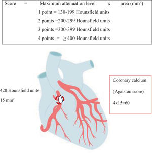 Assessment of coronary calcium using the Agatston scale. Example of a clinical case. A patient with coronary calcium with an attenuation of 420 Hounsfield units and an area of 15mm2 has Agatston scale score of 60.