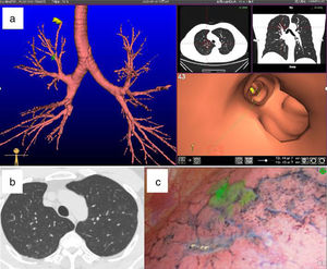 Localización intraoperatoria guiada por navegación virtual broncoscópica mediante verde de indocianina. (a) Imagen de NVB. (b, c) Imágenes de TC y fluorescencia de un nódulo en el segmento posterior del lóbulo superior derecho. Adaptado de Yang Q. et al.31.
