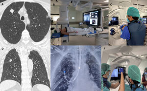 (A) Pulmonary nodule in the RUL on axial chest CT imaging. (B) Hybrid operating room setting. (C) ENB combined with CBCT. (D) Pulmonary nodule in the RUL visualized on coronal chest CT imaging. (E) Augmented fluoroscopy image showing the RUL nodule. (F) ENB combined with CBCT during the diagnostic phase, with transbronchial biopsy sampling.