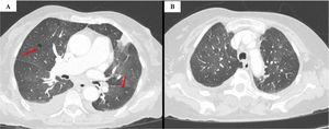 (A and B) Diffuse bilateral distribution of ground-glass opacities, predominantly in the upper lobes. There are also regular cystic lesions of approximately 10mm in size in the middle lobe and lower lobes (red arrow).