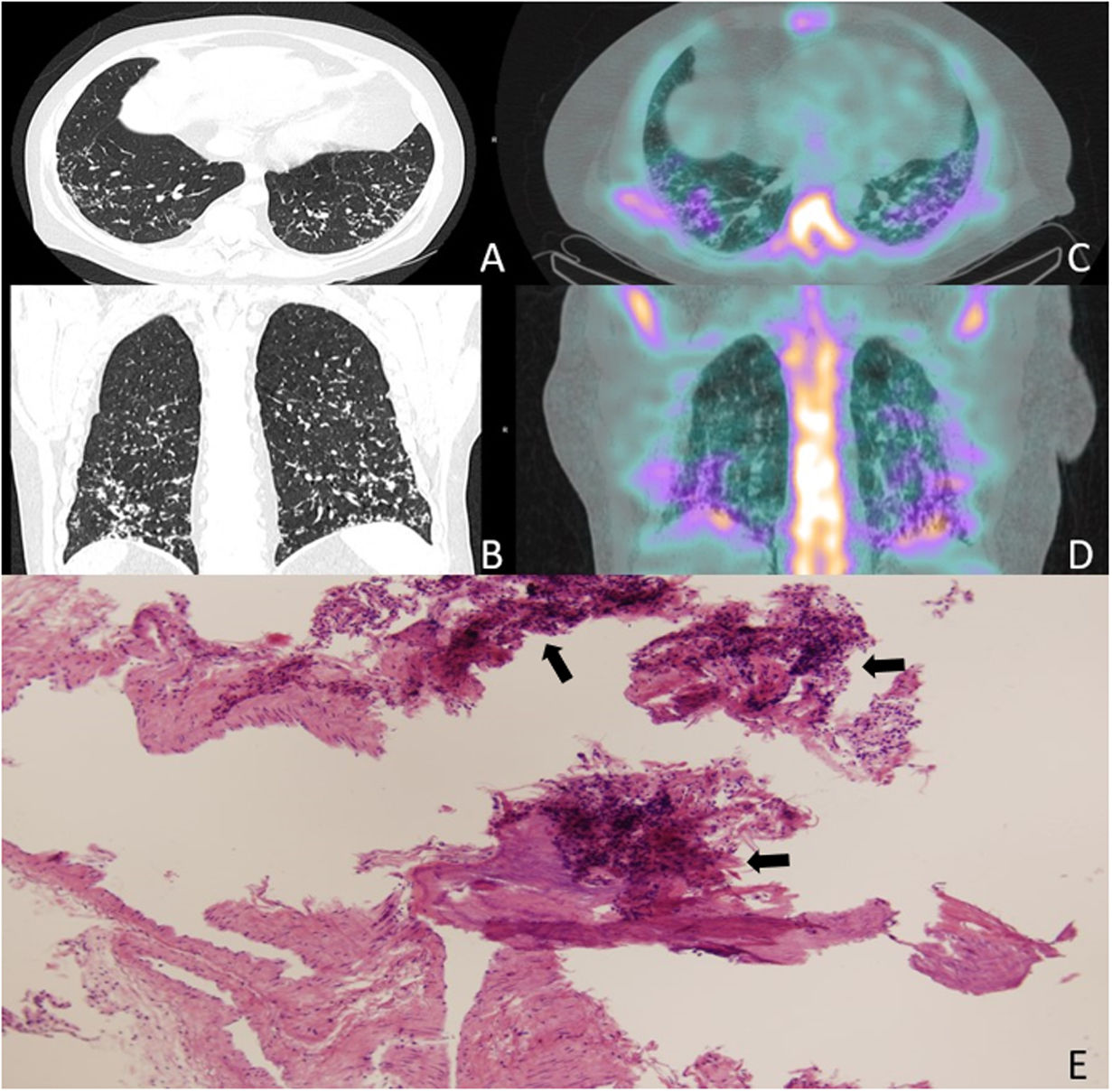 Pulmonary Calcifications: A Reflection of Renal Impairment | Open ...