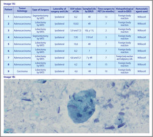 (A) Table description of the cases. (B) Abundant acellular foreign material of cylindrical morphology, associated with a histiocytic reaction and the presence of multinucleated giant cells of the foreign body type.