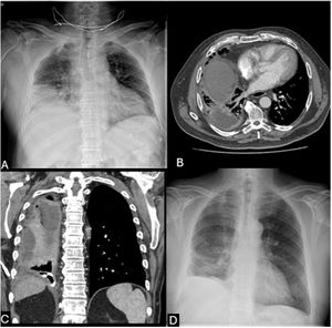 (A) Chest X-ray showed a right lower lobe consolidation containing air foci and ipsilateral pleural effusion. (B) Chest CT scan showed a complex multiloculated pleural collection in the right hemithorax with septations and compressive atelectasis. (C) Coronal CT reconstruction confirming the loculated pleural collection in the right hemithorax. (D) Follow-up chest-X-ray at discharge documents complete resolution of pleural effusion, lung re-expansion and minimal residual basilar opacities in the right hemithorax.