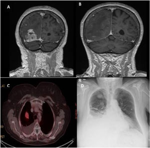 (A and B) A magnetic resonance scan showed a right occipital lesion of rounded morphology close to the confluence of the venous sinuses, with invasion of the transverse sinus. (C) A positron emission tomography scan showed in the lung parenchyma a solid nodule in the right lung, which shows a slight increase in uptake, with a suspicious appearance. (D) A chest X-ray showed right pleural effusion and a pulmonary nodule in the right upper lobe.