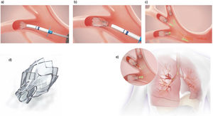 Placement of Zephyr endobronchial valves. (a–c) Endobronchial placement process with valve size measurement and release. (d) Illustration of the valve morphology with its most proximal portion. (e) Mechanism of action.