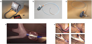 BVTA procedure. (a–c) BTVA equipment with application probe; (d and e) balloon placement and intrabronchial steam ablation. BTVA: bronchial thermal vapour ablation.