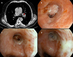 (A) Chest CT showing a 14mm solid-appearing nodular lesion within the left main bronchus (red arrow). (B) Bronchoscopy prior to brachytherapy: endobronchial lesion located at the carina between the left upper and lower lobes. (C) Follow-up bronchoscopy after 6 weeks of treatment: complete resolution of the lesion. (D) Bronchoscopy 6 months after treatment completion: post-radiation changes with no evidence of recurrence.