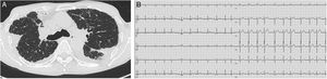 Representative imaging and electrocardiographic findings in an 80-year-old man with idiopathic pleuroparenchymal fibroelastosis. (A) Axial chest computed tomography image showing marked platythorax (flat chest index, 0.49) with upper-lobe-predominant pleuroparenchymal fibrosis. (B) Twelve-lead electrocardiogram demonstrating right axis deviation (QRS axis, +105°) with occasional premature atrial contractions.
