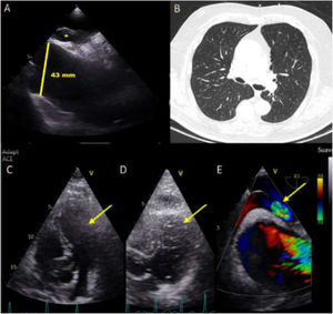 (A) Transthoracic echocardiography showing aortic root dilatation (yellow line) and the presence of a patent foramen ovale (PFO) (*). (B) Lung window showing no clinically significant parenchymal abnormalities. (C) Transthoracic echocardiography with agitated saline contrast performed in the supine position, showing no evidence of right-to-left shunting at the interatrial septum (arrow). (D) Contrast-enhanced transesophageal echocardiography performed in the sitting position, demonstrating marked right-to-left shunting through a patent foramen ovale (arrows). (E) Transesophageal echocardiography with color Doppler imaging showing a large patent foramen ovale with right-to-left flow (arrow). (*) Suspected interatrial septal defect/PFO region (depending on your image labeling).