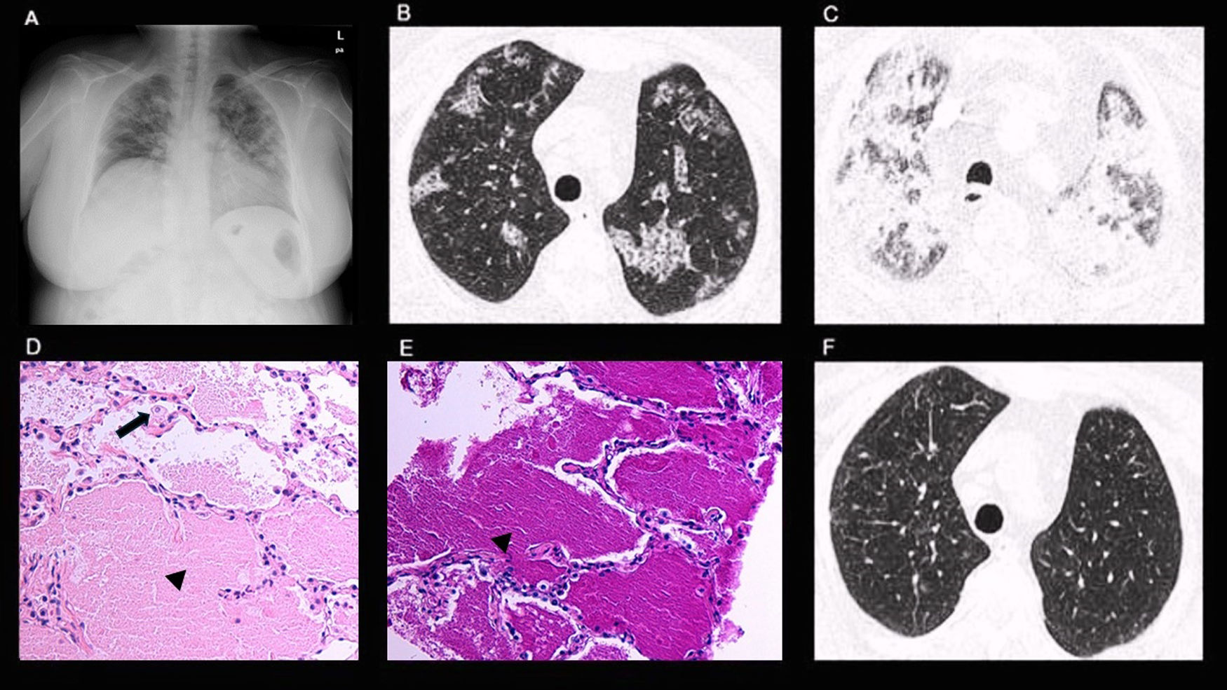 Pulmonary Alveolar Proteinosis With Atypical Presentation Mimicking ...