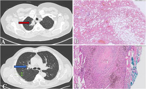 Case one. (A) CT scan showing an apical mass within the medial region of the upper right lobe (red arrow). (B) Pathological analysis revealing extensive dense collagenous material accompanied by lymphoplasmacytic inflammatory cellularity, vascular space dilation without atypia, and hyalinized areas, consistent with pulmonary hyalinizing granuloma. Adjacent lung tissue displays distorted architecture due to a fibroinflammatory process, patchy distribution, and heterogeneous temporal appearance, consistent with usual interstitial pneumonia. Case two. (C) CT scan showing right hilar lymphadenopathies with partial calcification up to 15mm (blue arrow) and diffuse multilobar micronodularity (green arrows). (D) Pathological examination revealing subpleural hyalinized nodules surrounded by anthracotic pigment-laden macrophages without evidence of necrosis, consistent with pulmonary hyalinizing granuloma.