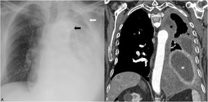 Pleural mesothelioma. (A) Chest radiograph showing massive left pleural effusion, thickening of the parietal pleura (white arrow) and left mediastinal widening (black arrow). (B) Chest CT shows diffuse pleural thickening involving the mediastinal pleura (black asterisk), and loculated pleural effusion (white asterisks).