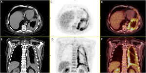 [18F]FDG PET/CT with left pleural effusion in the CT study (A and B). The [18F]FDG images (C and D) and the [18F]FDG PET/CT fusion images (E and F) present increased glycolytic metabolism with an encapsulation pattern. Pathological diagnosis: mesothelioma.