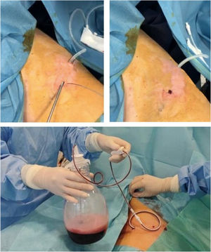 Indwelling pleural catheter insertion technique.