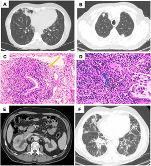 (A) Reticulonodular pattern in both lung bases. (B) Nodular lesions. (C) Peribronchial lymphocytic infiltrate (yellow arrow). (D) Bronchiolar structures are surrounded by a lymphocytic inflammatory infiltrate (blue arrow). (E) Left kidney with thinning of the parenchyma with pyelocaliceal ectasia, suggesting chronic etiology. Adenopathies adjacent to both renal hili. (F) Interstitial pattern of the glass, with the addition of areas of ground glass.