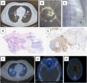 Computed tomography image of the biopsied nodule and its draining bronchus (A). Radial EBUS images of lung lesion by ultrasound (B) and fluoroscopy (C). Histological section stained with hematoxylin–eosin showing a small nest of cells with a meningotheloid appearance in the interstitium (D) and focal positivity (brown) for somatostatin receptors in the complementary immunohistochemistry study (E). Uptake increase in SPECT associated with lung lesions (F) and bone metastasis (G and H).