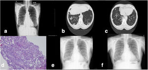 (a) The first chest X-ray upon admission of the patient. (b and c) An image of the lower lobes on CT during admission. (d) Transbronchial biopsy showing interstitial lymphocytic inflammatory infiltrate with eosinophils and pneumocyte hyperplasia. (e) Chest X-ray 4 weeks after treatment withdrawal with minimal infiltrates in the right lower lobe. (f) Chest X-ray 3 months after withdrawal of flecainide and corticosteroid treatment. It does not present infiltrates.