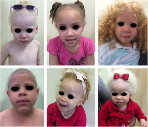 Fenótipo no albinismo. Ampla variabilidade fenotípica entre crianças portadoras de albinismo oculocutâneo.