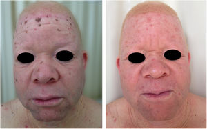 Tratamento dos danos actínicos. Paciente albino com múltiplas queratoses actínicas e lentigos solares tratado com crioterapia.