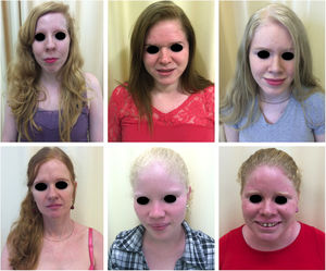 Fenótipo no albinismo. Ampla variabilidade fenotípica entre mulheres portadoras de albinismo.