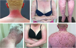 Danos actínicos no albinismo. Pacientes albinos apresentando danos actínicos nas áreas fotoexpostas.