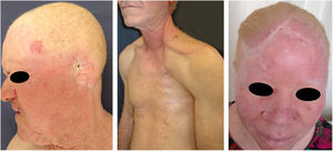 Sequelas do câncer da pele. Pacientes albinos com múltiplas cicatrizes e mutilações por cirurgias prévias para excisão de cânceres da pele.