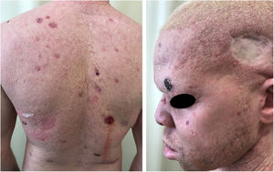 Morbimortalidade associada ao câncer da pele. Paciente albino jovem com múltiplos tumores (CBC e CEC) e cicatrizes cirúrgicas de excisões prévias.