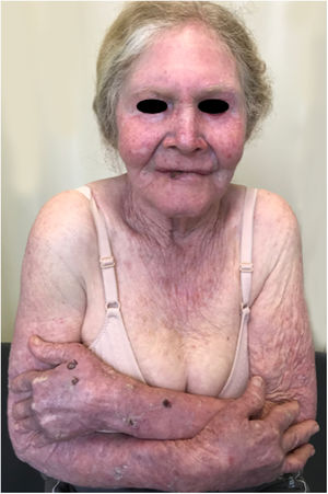 Dano solar acumulativo‐exposição desprotegida. Paciente albina idosa com múltiplos danos actínicos em áreas fotoexpostas. Histórico de carcinoma basocelular e carcinoma espinocelular.