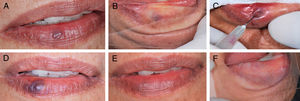 A, Aspecto clínico inicial da malformação vascular, vesícula arroxeada de 3mm em lábio inferior (paciente 16).B, Diascopia positiva para lesão vascular feita durante o exame clínico.C, Aplicação do oleato de monoetanolamina a 5% com aspiração positiva de sangue no lúmen do vaso. D, Aspecto clínico da lesão no 7° dia de pós‐operatório. E, Aspecto clínico final da lesão vascular no 28° dia pós‐operatório. F, Diascopia negativa final da região onde havia a MV.