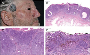 A, Carcinoma basocelular (CBC)‐ nasal; Melanoma‐ região temporal direita; B, CBC‐ Ninhos de células basaloides (Hematoxilina & eosina, 10×); C, Paliçada periférica (Hematoxilina & eosina, 100×); D, Melanoma – ninhos de melanócitos atípicos e disseminação pagetoide (Hematoxilina & eosina, 200×).