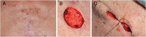 A, Carcinoma basocelular na região esternal; B, Exérese; C, Correção da dog‐ear.