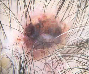 À dermatoscopia, observa‐se crosta hemática e zona periférica eritematosa com glóbulos mal definidos.