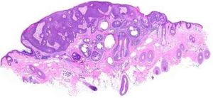 Sebaceoma. Neoplasia epitelial assimétrica disposta em “v”, cujo vértice aponta para a profundidade. Há área de acantose à esquerda e predomínio de massas dérmicas à direita, que conferem assimetria intrínseca ao conjunto, característica pouco usual para esse tipo de proliferação. As massas têm formas e tamanhos regulares, predominantemente arredondadas ou ovais, e estão imersas em estroma colagenizado. Nesse aumento panorâmico já são percebidos grupamentos de células epiteliais de citoplasma pálido que permeiam as massas, representativas de sebócitos maduros (hematoxilina & eosina, 20×).