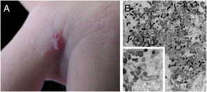 Angiomatose bacilar: A, Lesão angiomatosa única no terceiro interdígito da mão direita de mulher; B, Microscopia eletrônica de transmissão de fragmento cutâneo com inúmeros bacilos Gram‐negativos de distribuição intra e extracelular (×1.200, inset ×16.000).