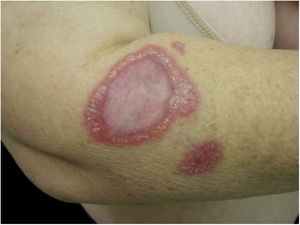 Granuloma anular apresentado por uma mulher de 52 anos. O DNA de B. henselae foi amplificado em fragmento de linfonodo mediastinal e no sangue da paciente.