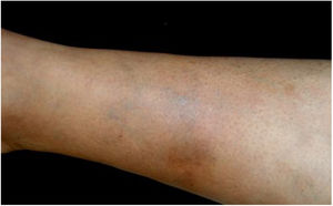 Paniculite esclerosante na perna direita de uma mulher de 32 anos com histórico de anemia recorrente com origem desconhecida. A paciente teve posteriormente pesquisa do DNA de B. henselae positiva no sangue.