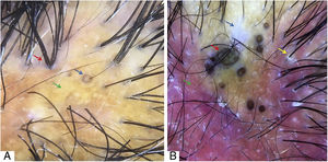 A, Ponto amarelo “3D” (seta azul), politriquia (seta vermelha) e áreas amarelas desestruturadas (seta verde). B, Área branca amorfa (seta azul), pontos marrons largos (seta vermelha), eritema difuso (seta verde), escamas perifoliculares (seta amarela). Tricoscopia feita com 3Gen DermLite® II Hybrid M com luz polarizada com líquido (A) e sem líquido (B) de interface (álcool 70%); 20× de ampliação.