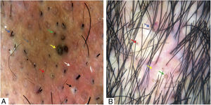 A, Pelos fraturados (seta azul), pelos curtos de repilação (seta vermelha), pontos pretos (seta verde), pontos marrons largos (seta amarela), pústulas foliculares (seta preta), eritema interfolicular (seta branca) e aberturas foliculares vazias (seta cinza). B, Fendas cutâneas com pelos emergentes (seta azul), pontos amarelos (seta vermelha), pontos amarelos “3D” (seta verde) e eritema peri e interfolicular (seta amarela). Tricoscopia realizada com 3Gen DermLite® II Hybrid M com luz polarizada e com líquido de interface (álcool 70%); 20× de ampliação.