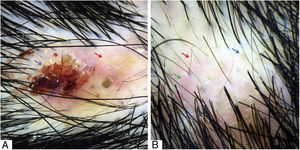 A, Crosta hemática (seta azul) e área eritematoamarelada desestruturada (seta vermelha). B, Pontos amarelos (seta azul), pelos curtos de repilação (seta vermelha) e eritema interfolicular (seta verde). Tricoscopia feita com 3Gen DermLite® II Hybrid M com luz polarizada e com líquido de interface (álcool 70%); 20× de ampliação.
