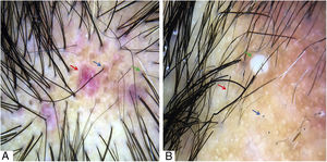 A, Pontos vermelhos (seta azul), eritema peri e interfolicular (seta vermelha) e pigmentação cinza‐azulada perifolicular (seta verde). B, Pontos pretos (seta azul), pelos em ponto de exclamação e distróficos (seta vermelha) e pústula (seta verde). Tricoscopia feita com 3Gen DermLite® II Hybrid M com luz polarizada e com líquido de interface (álcool 70%); 20× de ampliação.