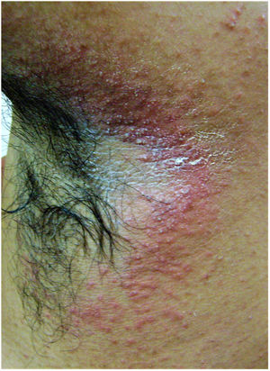 Imagem clínica de lesão de tinha incógnita na axila direita de um paciente jovem, do sexo masculino – placa eritematosa minimamente elevada, com bordas mal definidas, superfície brilhante com pápulas levemente escamosas e perifericamente dispersas. As lesões surgiram quatro meses antes; o paciente apresentava histórico de aplicação intermitente de creme antifúngico esteroide e ingestão oral de itraconazol.