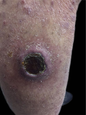 Úlcera com crosta central, membro inferior esquerdo.