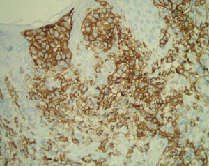 Imuno‐histoquímica – CD1a.