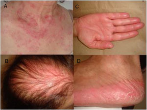(A) Lesões eritematosas no V esternal; (B) Eritema na área de alopecia androgenética; (C e D) Síndrome de mãos e pés com eritema e descamação.