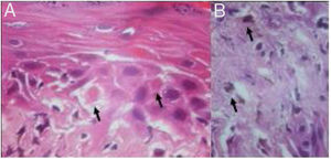 (A) Queratinócitos necróticos (setas) (Hematoxilina & eosina, 400×). (B) Derrame pigmentar (setas) (Hematoxilina & eosina, 400×).