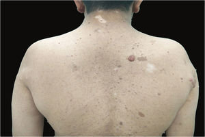 Máculas café‐com‐leite, neurofibromas com halo perilesional e manchas de vitiligo no dorso.